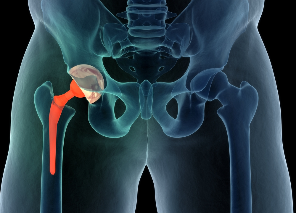 Anterioir Hip Replacement Surgery About Phoenix Spine